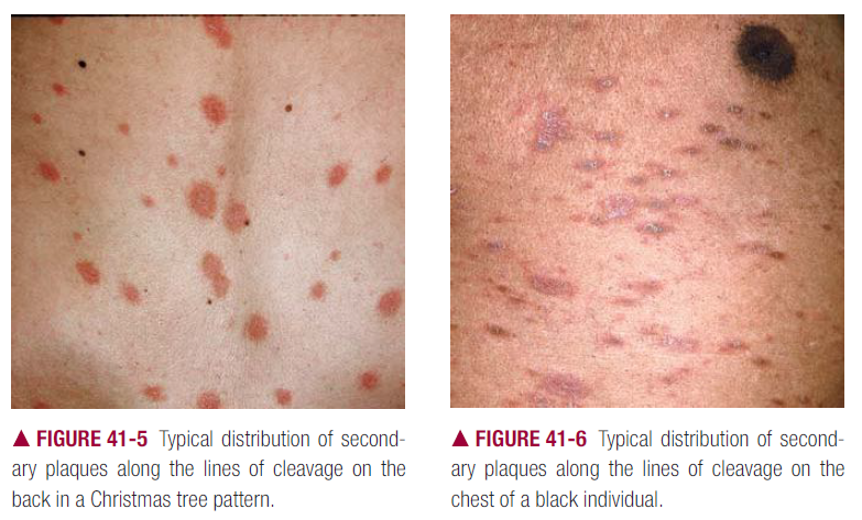Pityriasis Alba-Topic Overview - WebMD